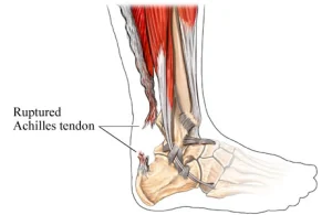 achilles_tendon_rupture